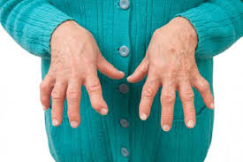 Artritis reumatoide, como curarla